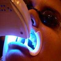 Sbiancamento dentale con laser Sforzacosta di Macerata